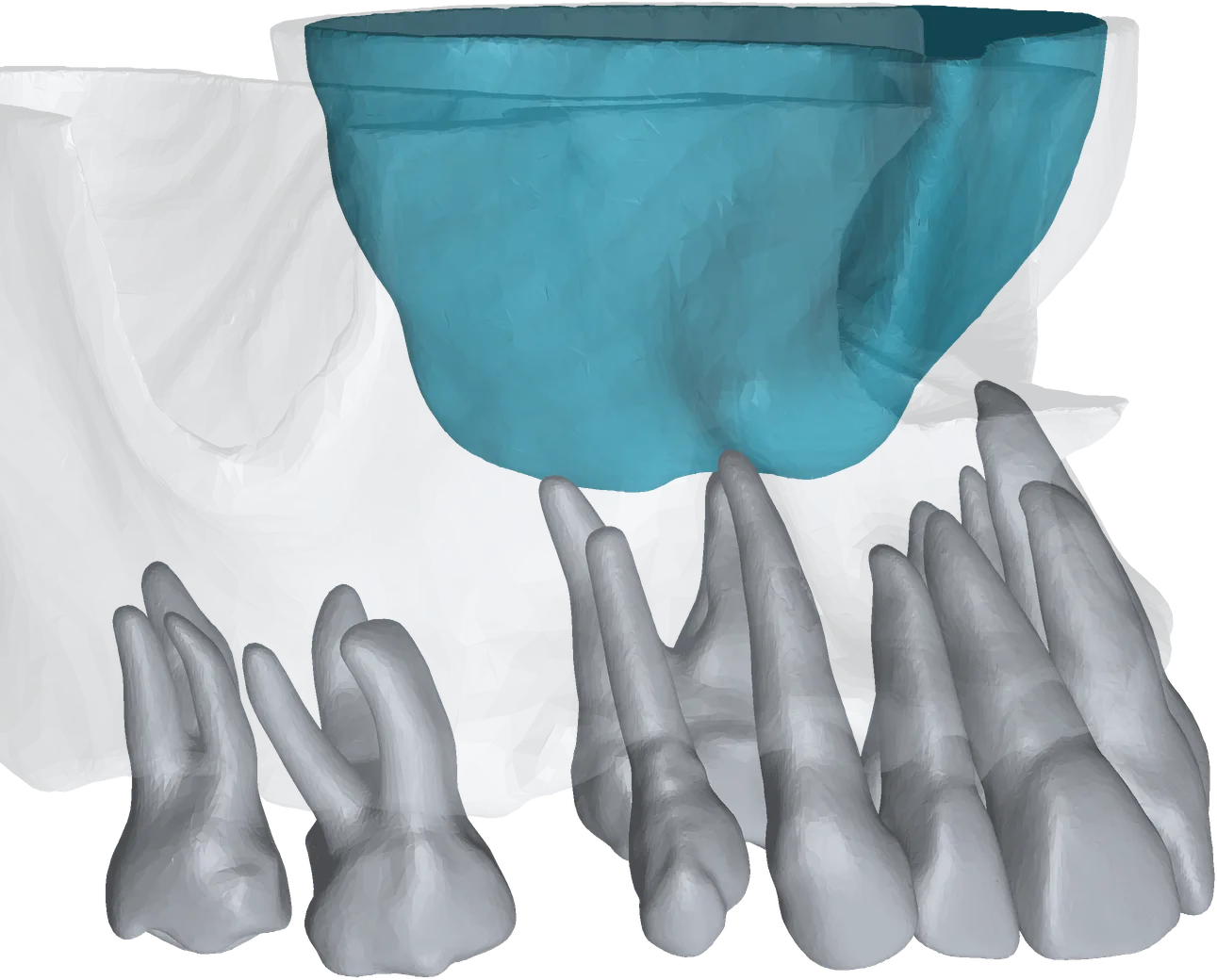 The sample case from the patient's left with the left maxillary sinus highlighted